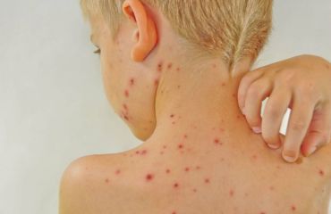 Điều trị dị ứng mẫn ngứa bằng thảo dược