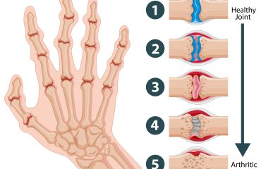 ĐIỀU TRỊ HỘI CHỨNG ỐNG CỔ TAY: KỸ THUẬT TIÊM KHỚP CỔ TAY HIỆU QUẢ