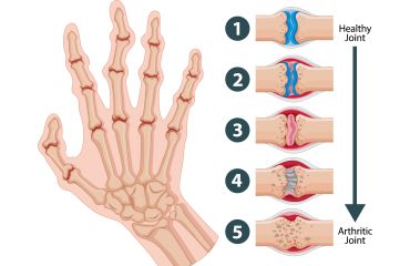 Điều Trị Hội Chứng Ống Cổ Tay: Kỹ Thuật Tiêm Khớp Cổ Tay Hiệu Quả
